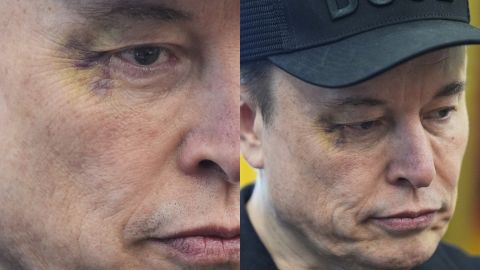 ¿Por qué Elon Musk tenía un ojo morado en su última aparición junto a Trump?