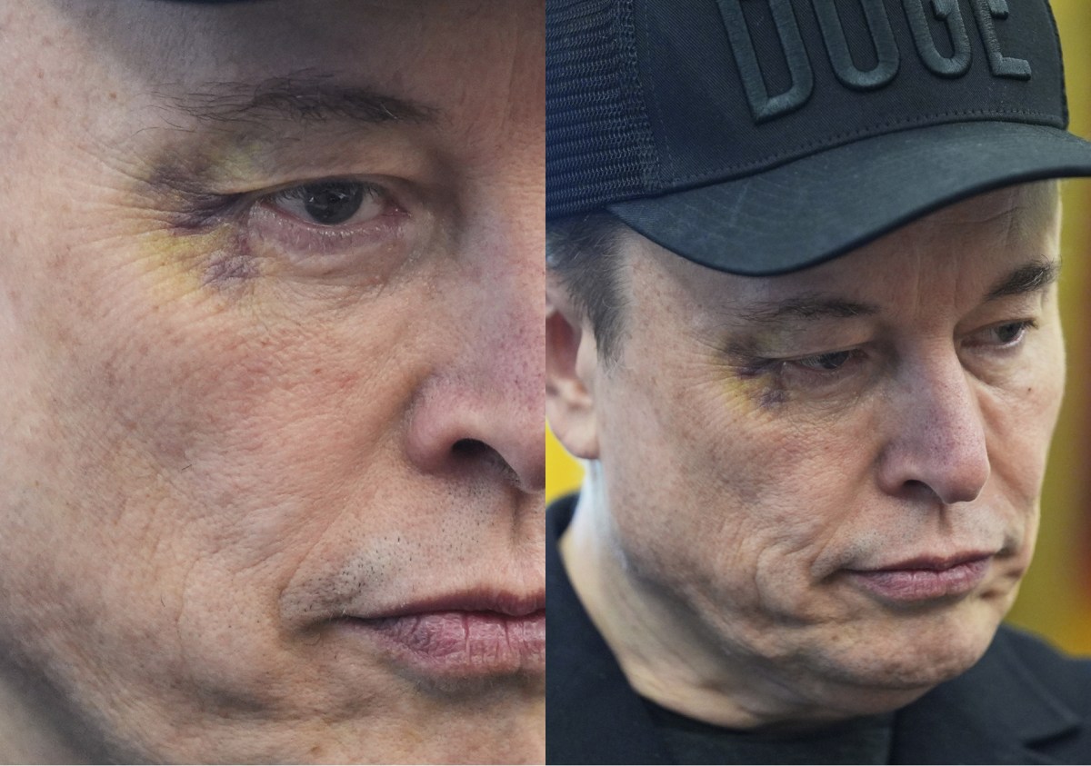 ¿Por qué Elon Musk tenía un ojo morado en su última aparición junto a Trump?