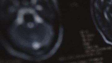 La medicina ha evolucionado en la investigación sobre la detección y el tratamiento del Alzheimer.