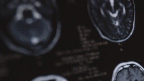 La medicina ha evolucionado en la investigación sobre la detección y el tratamiento del Alzheimer.