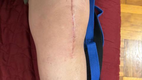 Una paciente hispana que padece de artritis fue sometida a un reemplazo de rodilla.