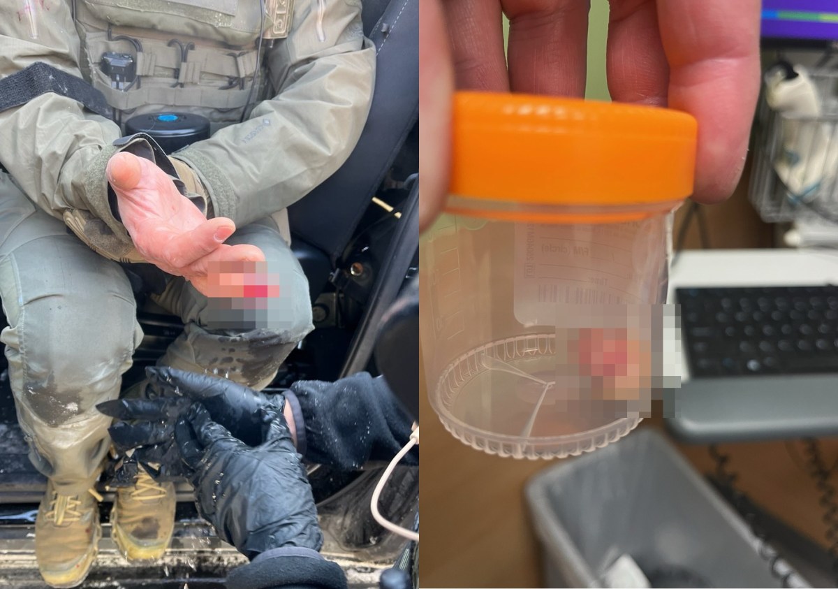 DHS acusa a un manifestante de Minnesota de arrancarle un dedo a un agente federal con un mordisco