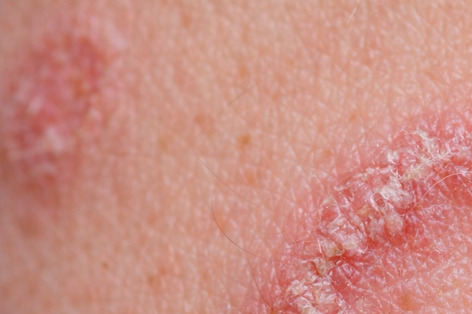 Lesión circular rojiza en la piel compatible con infección por hongo Trichophyton mentagrophytes tipo VII