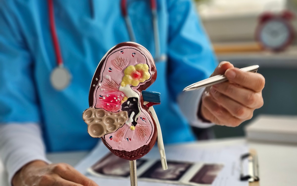 Cómo saber si tengo piedras en los riñones: 3 señales previas al dolor intenso