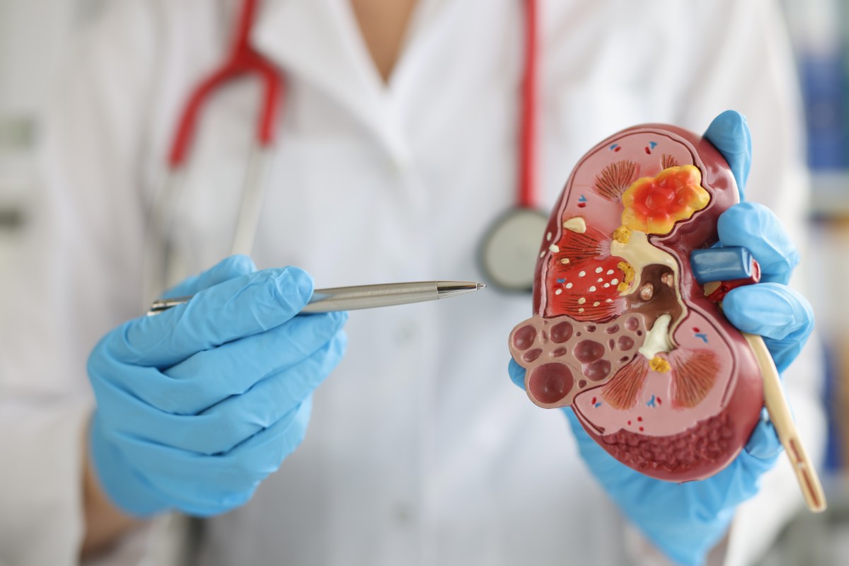 El medicamento que más daña los riñones y lo sigues tomando: advierten médicos