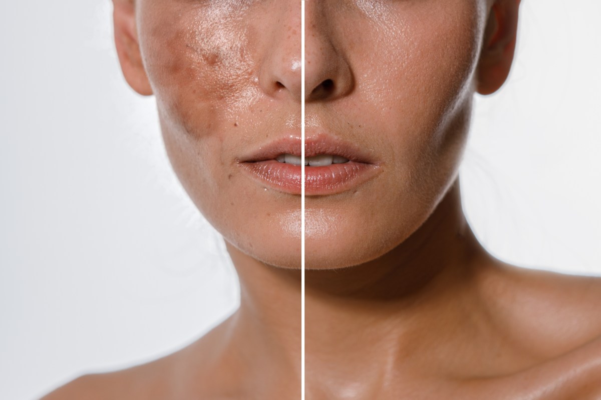 La tecnología redefine el diagnóstico del melasma