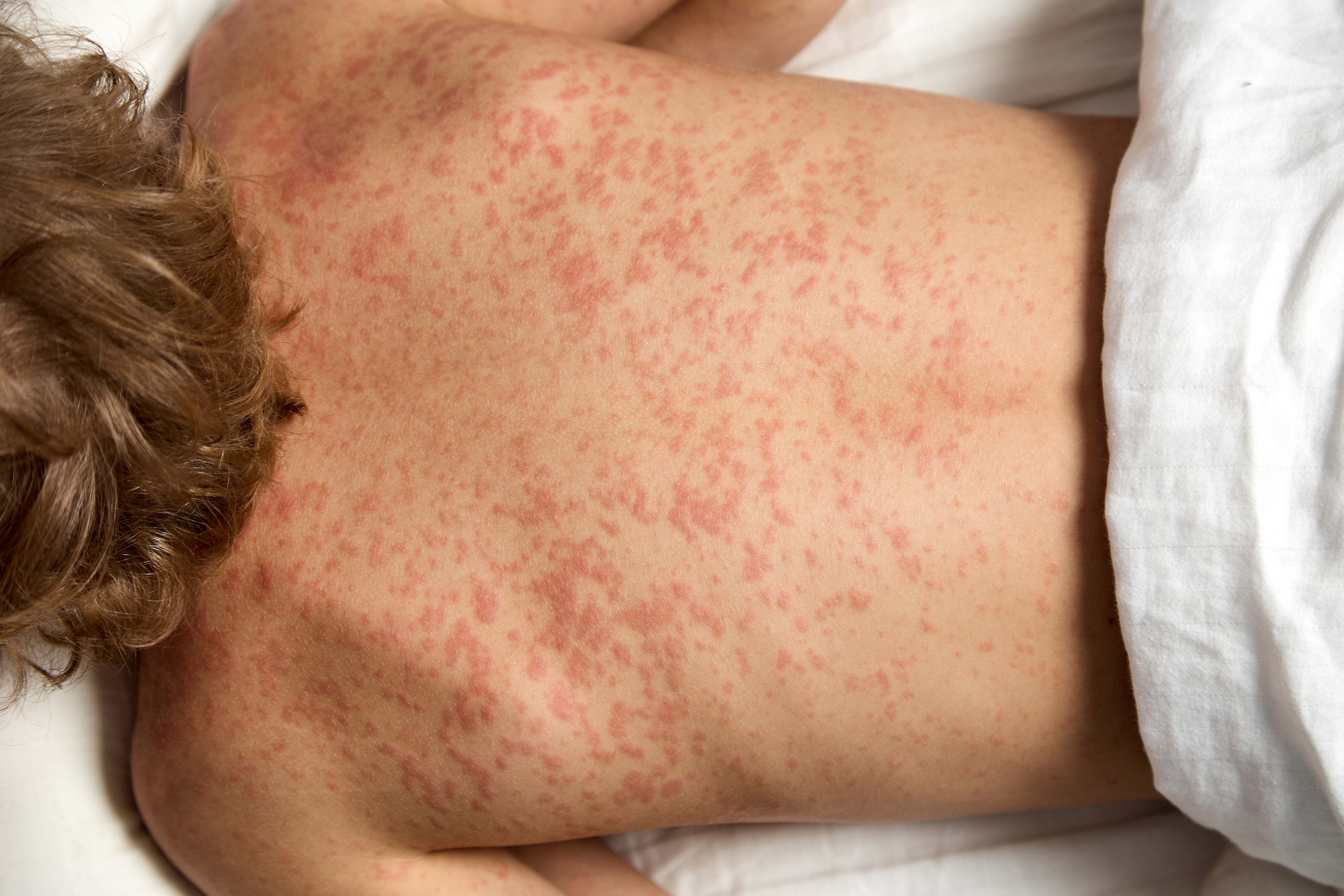 Measles Cases in Manhattan and Nassau Test New York’s Herd Immunity—Travel, Not Panic, Advised