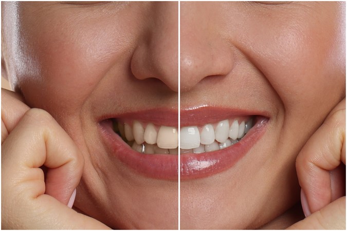 Un blanqueamiento dental no ocurre de la noche a la mañana, sino que es un tratamiento progresivo que requiere de cuidados.