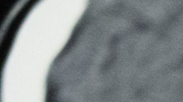 Nicola "Nicky" Hillier, sobrevive a meningitis.